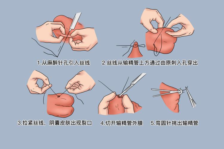 输精管结扎