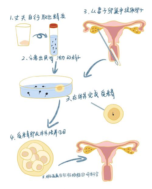 取卵取精
描述: 本文详细介绍了试管婴儿移植全过程，包括前期准备、取卵取精、体外受精、胚胎培养及移植等阶段，结合模拟图解让读者清晰了解，为有相关需求的家庭提供知识参考 。