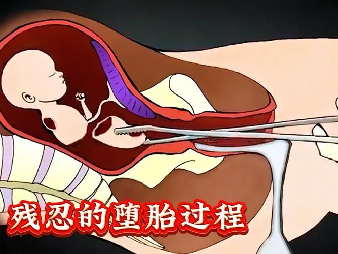 多次打胎