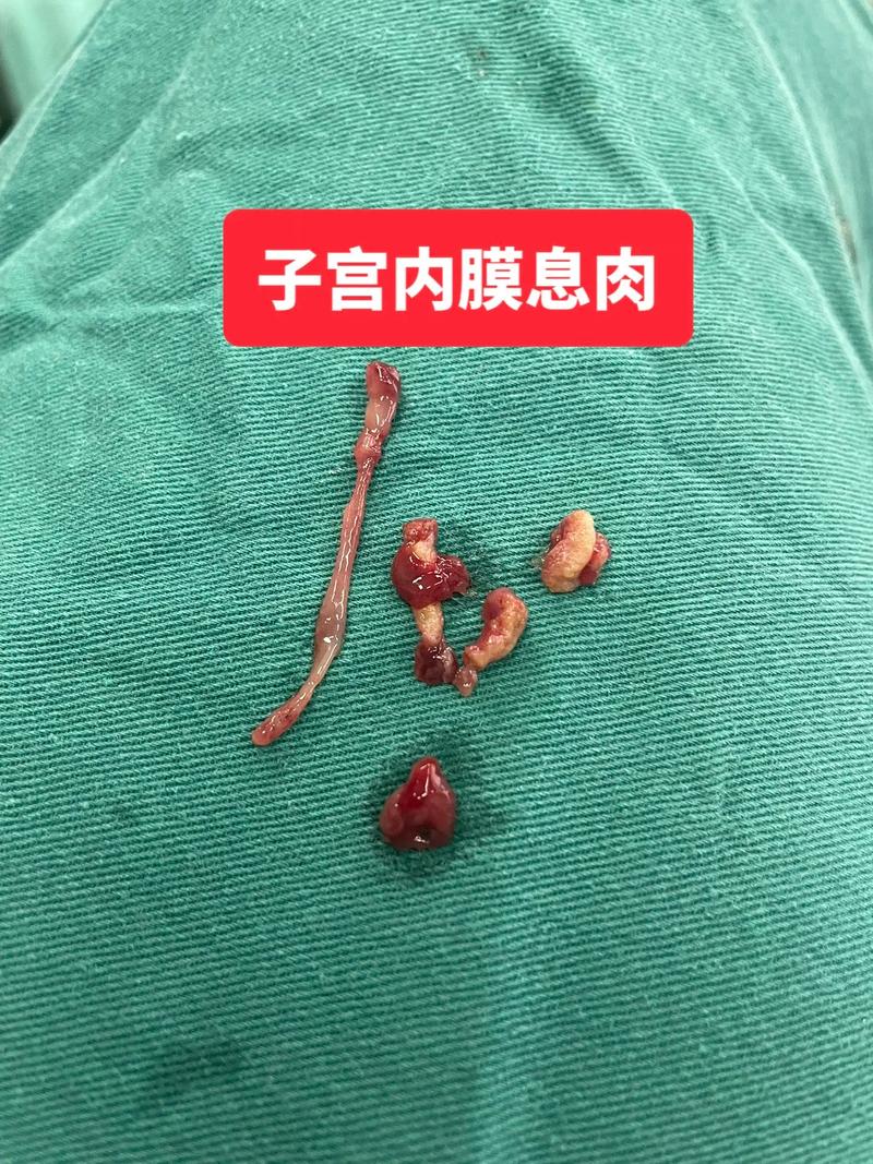 子宫内膜息肉