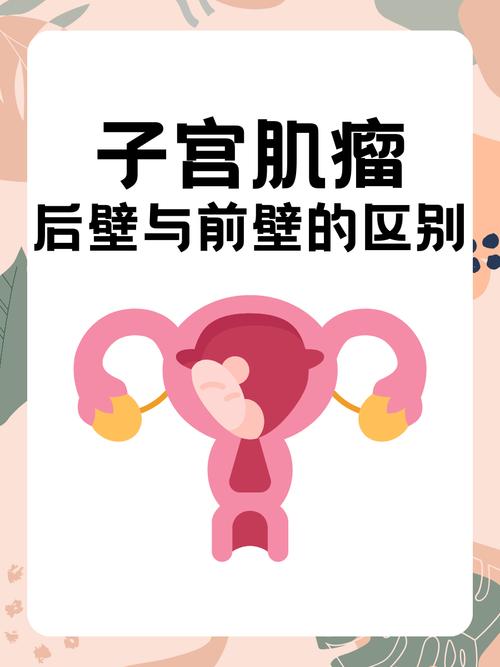 后壁肌瘤