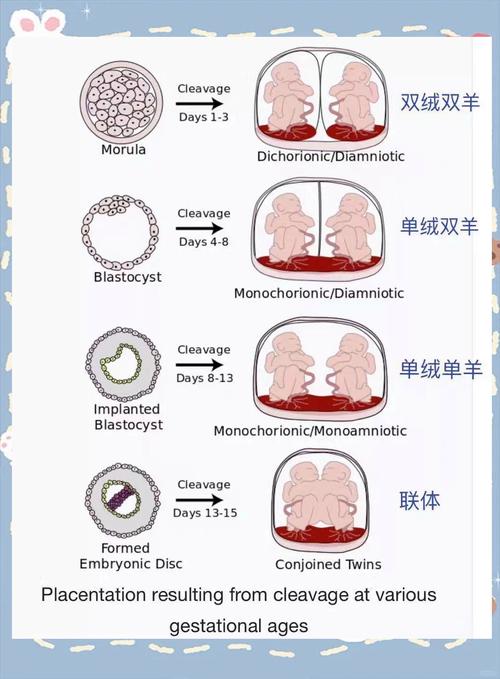 双胎判断