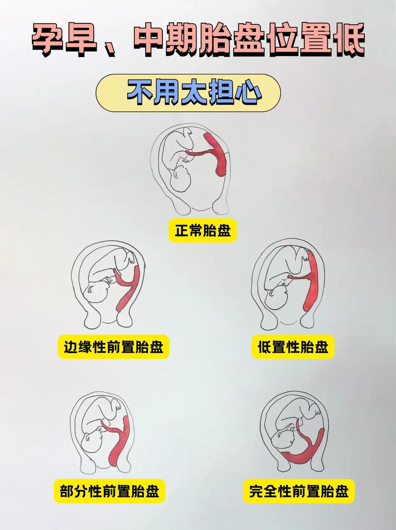 低胎盘