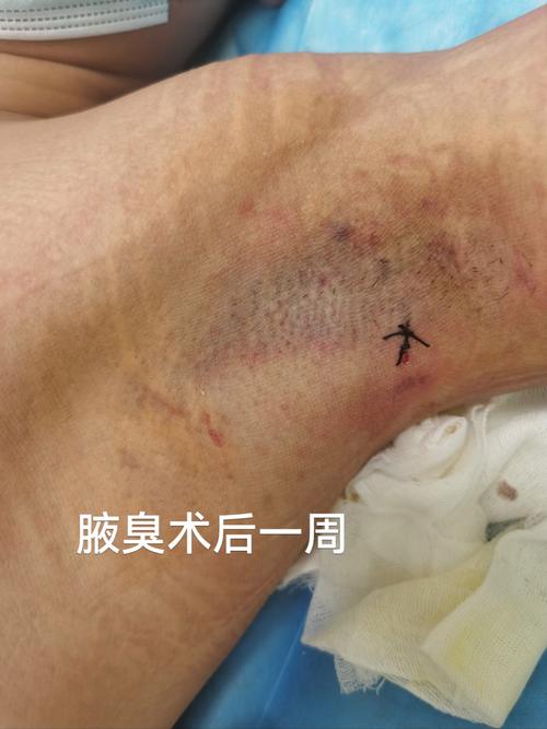 狐臭康复