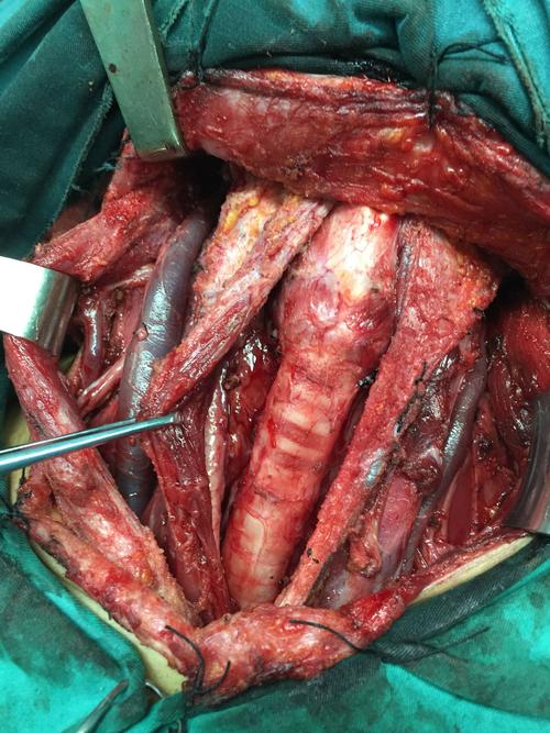 甲状腺切除