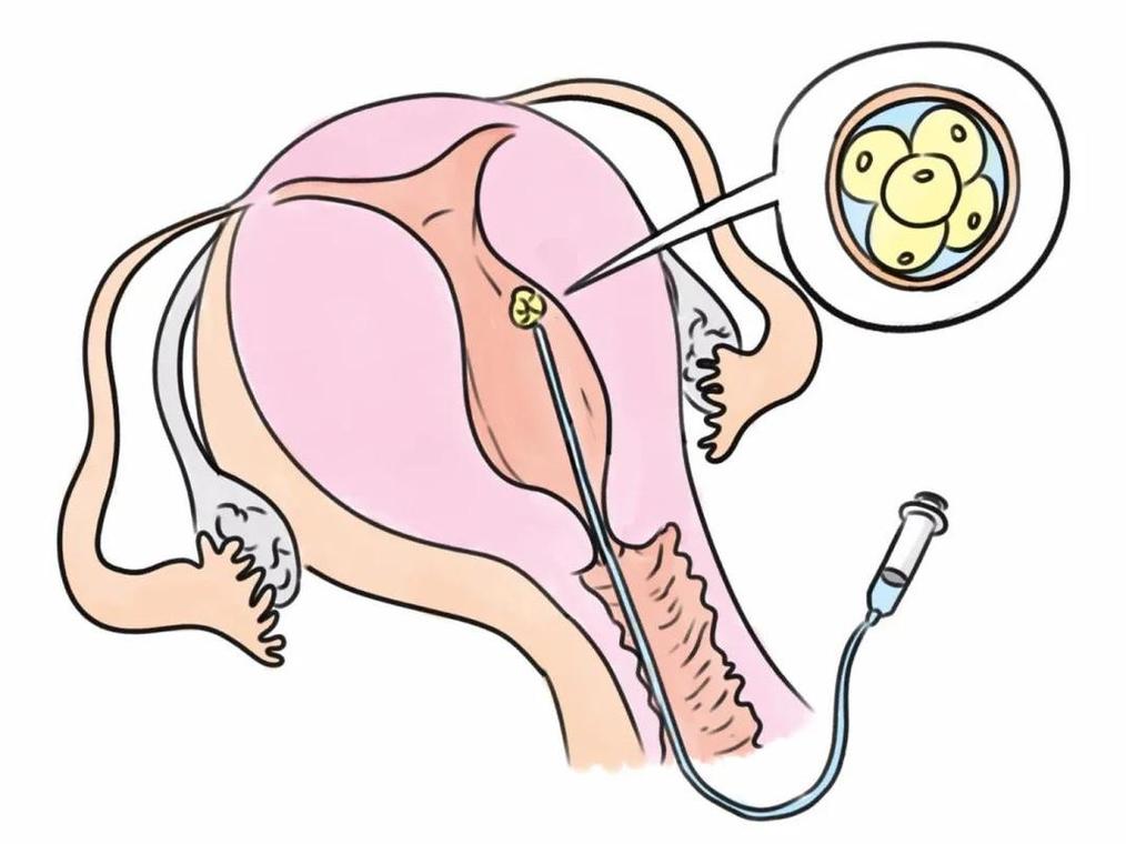 内膜分离：试管婴儿的关键步骤吗？
