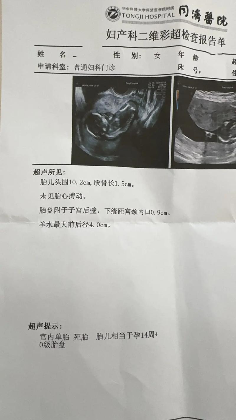 四月胎停