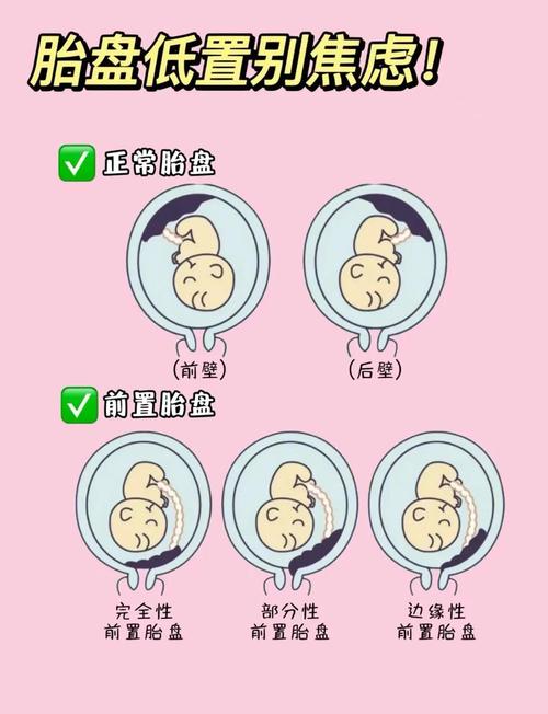 胎盘低置