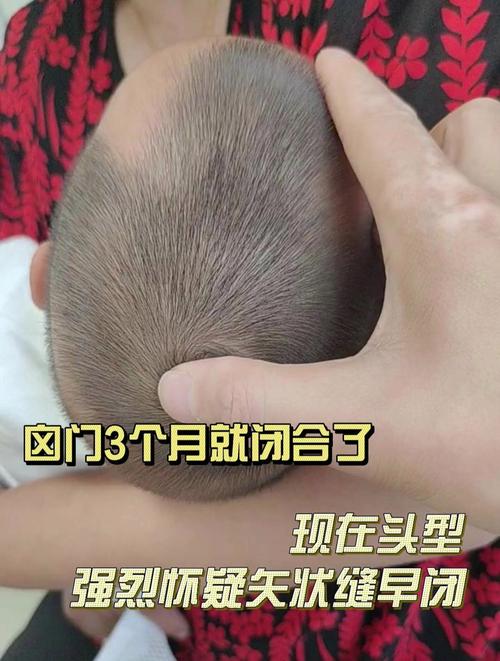 囟门早闭