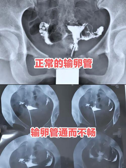 输卵管造影