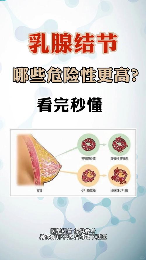  乳腺结节